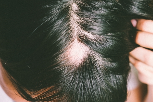 女性の中でも抱える髪の悩み〜女性の円形脱毛症とは